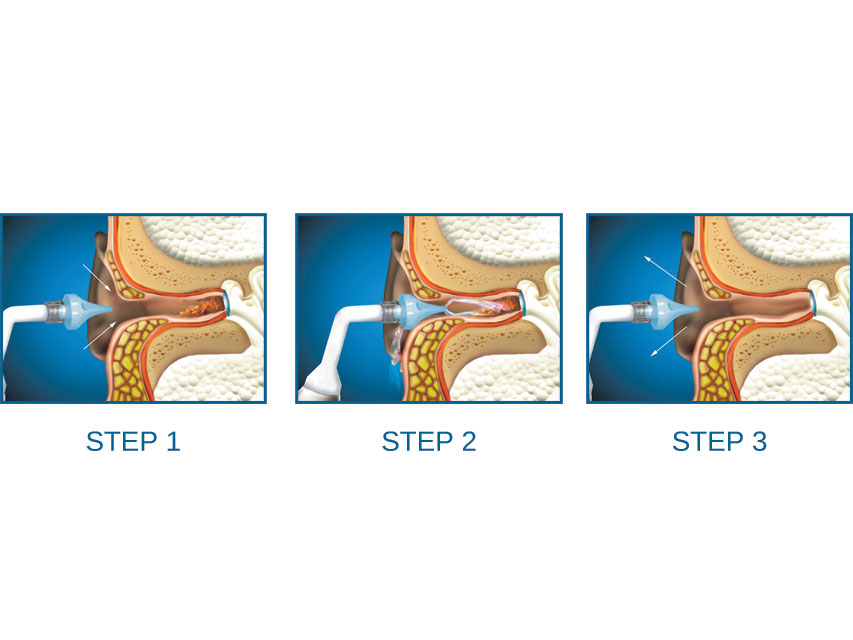 KIT D'IRRIGAZIONE AURICOLARE PER LAVAGGIO SPRAY OTOCLEAR - bottiglia da 500 ml