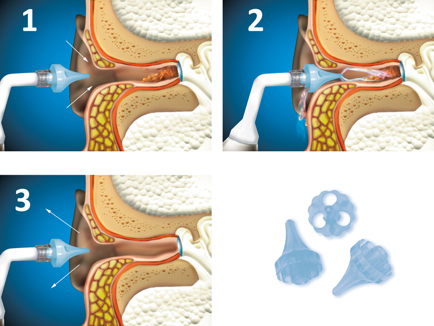 PUNTE OTOCLEAR - ricambio per 25855, 25858